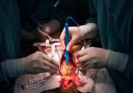 Endocarditis Surgery 2 Endocarditis Surgery 2