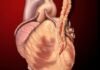 Coronary Artery Bypass Surgery
