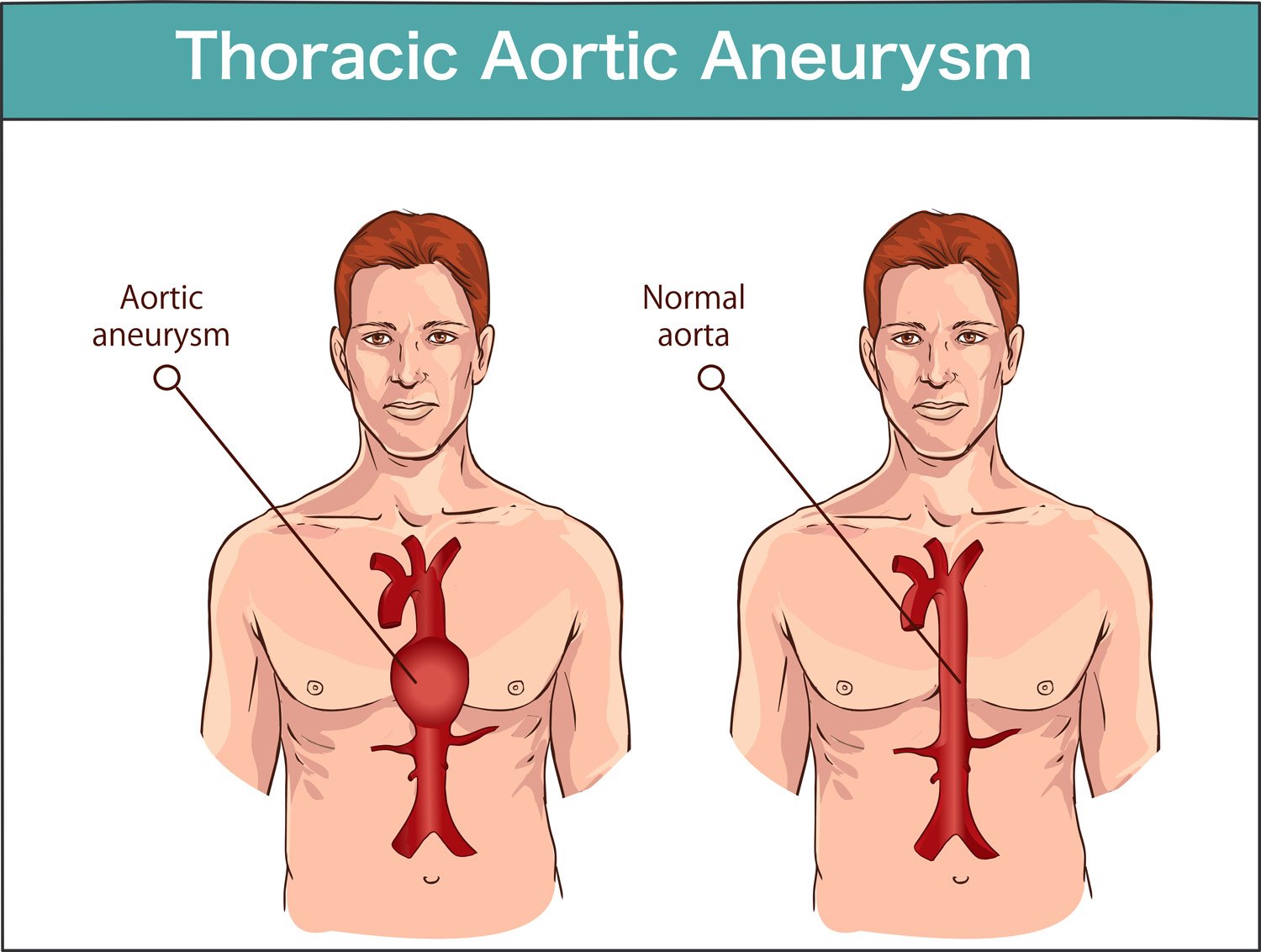 Did You Know What A Thoracic Aortic Dissection Is Cardiac Surgery Online